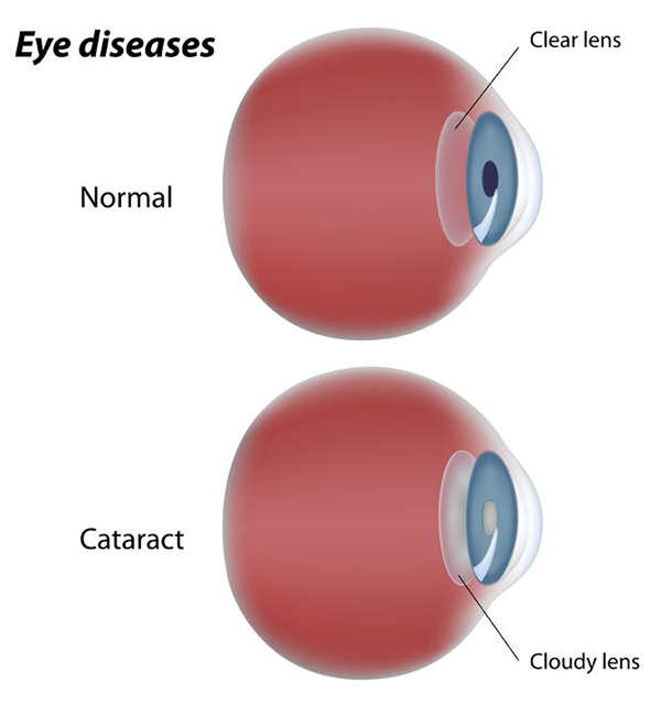 eye diseases in turnersville