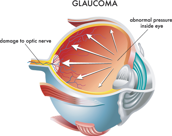 glaucoma treatment in turnersville