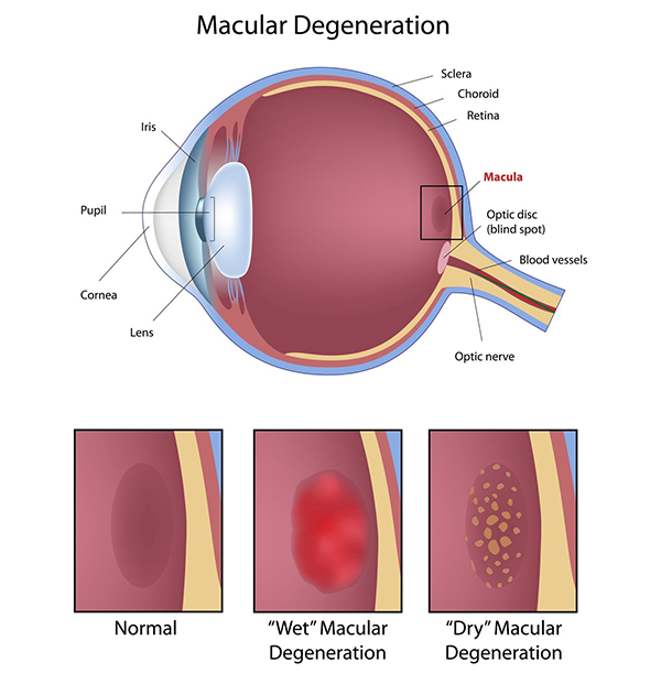 macular degeneration in turnersville