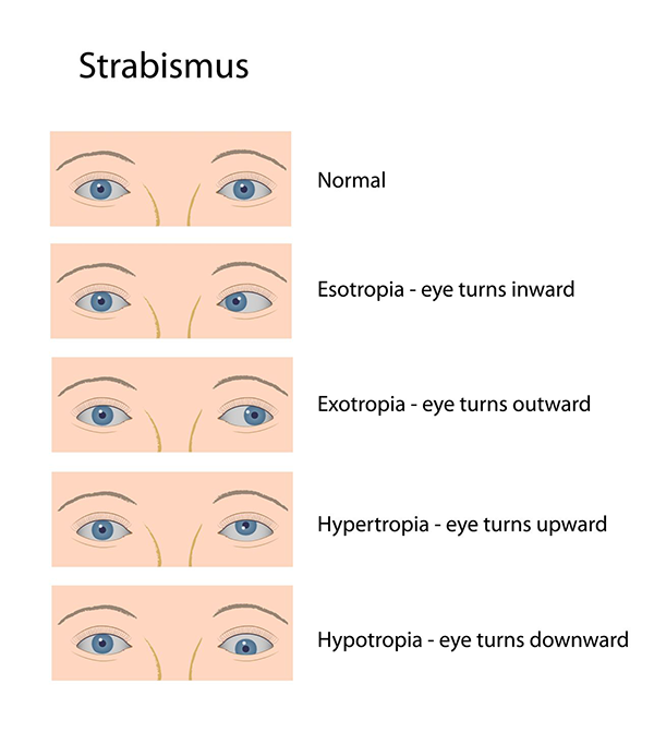 strabismus in turnersville