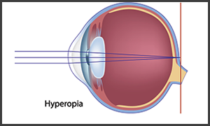 glaucoma in turnersville