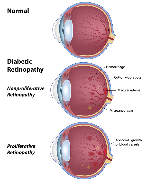 vision loss in turnersville