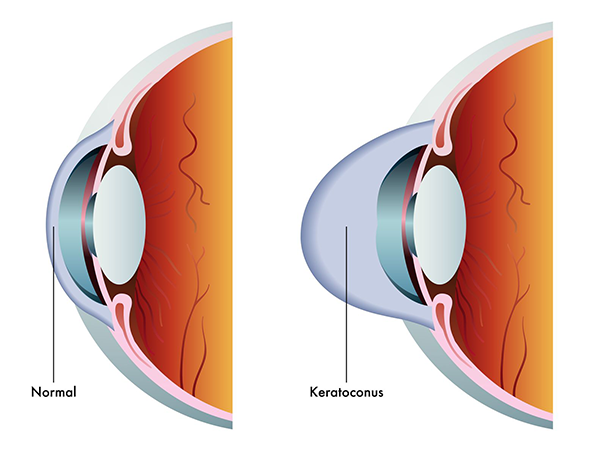 keratoconus in turnersville