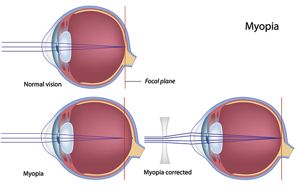 nearsightedness in turnersville