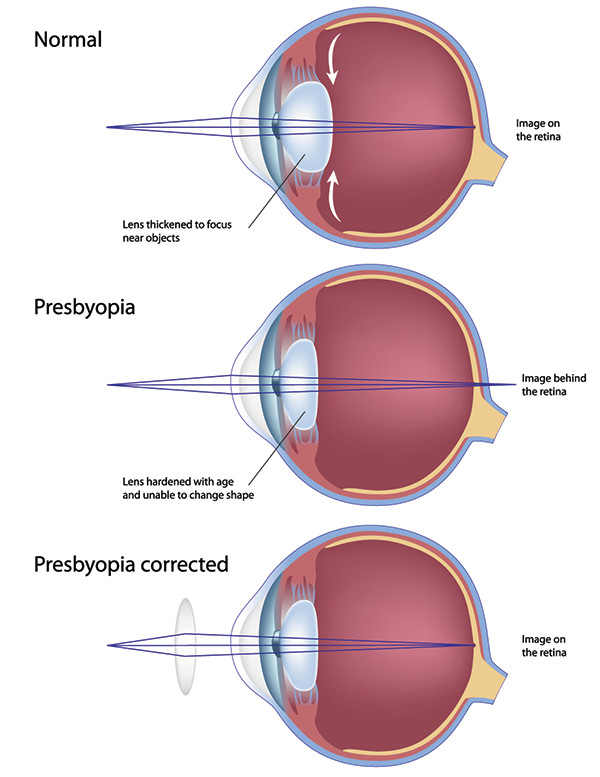 presbyopia in turnersville